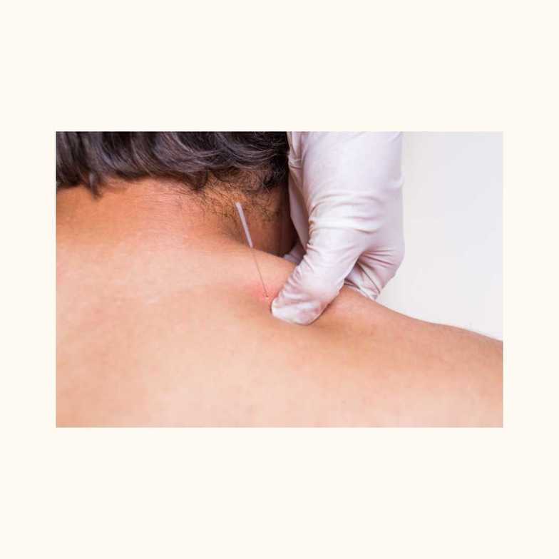 trigger point therapy , acupuncture 