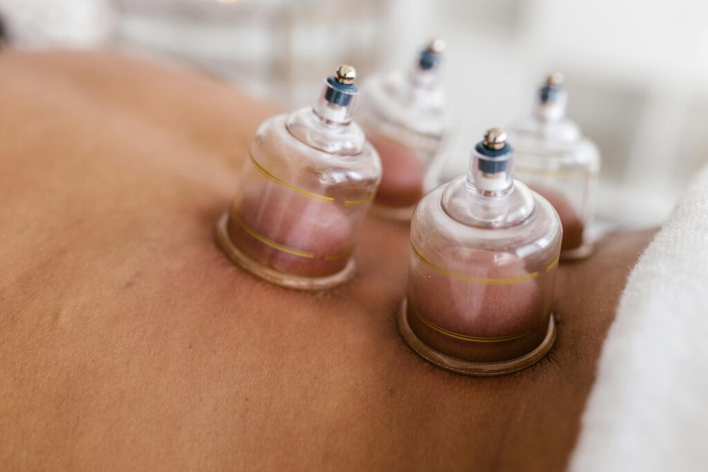 pexels-photo-8312830-8312830-1 Detailed image of cupping therapy on a person's back, showcasing alternative medicine practice.